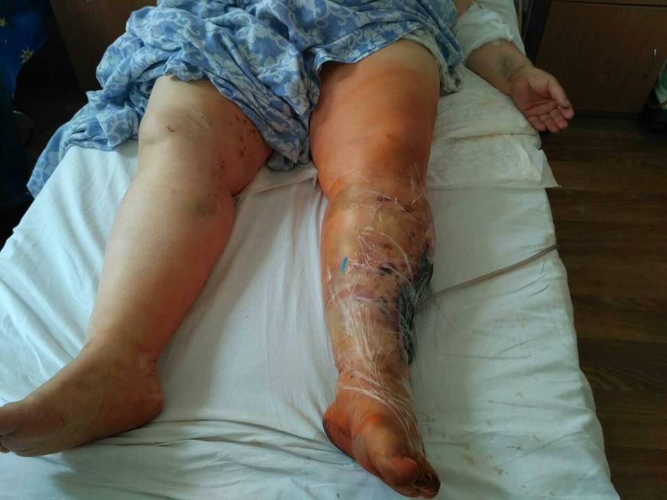 Осколками від вибуху вогнегасника жінці сильно поранило ногу