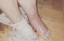 В России врачи по ошибке ампутировали пенсионерке не ту ногу (фото)