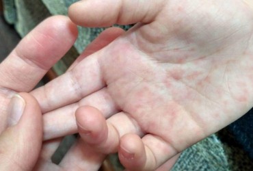 Корь в Европе: ВОЗ призывает к срочной вакцинации в связи с ростом заболеваемости