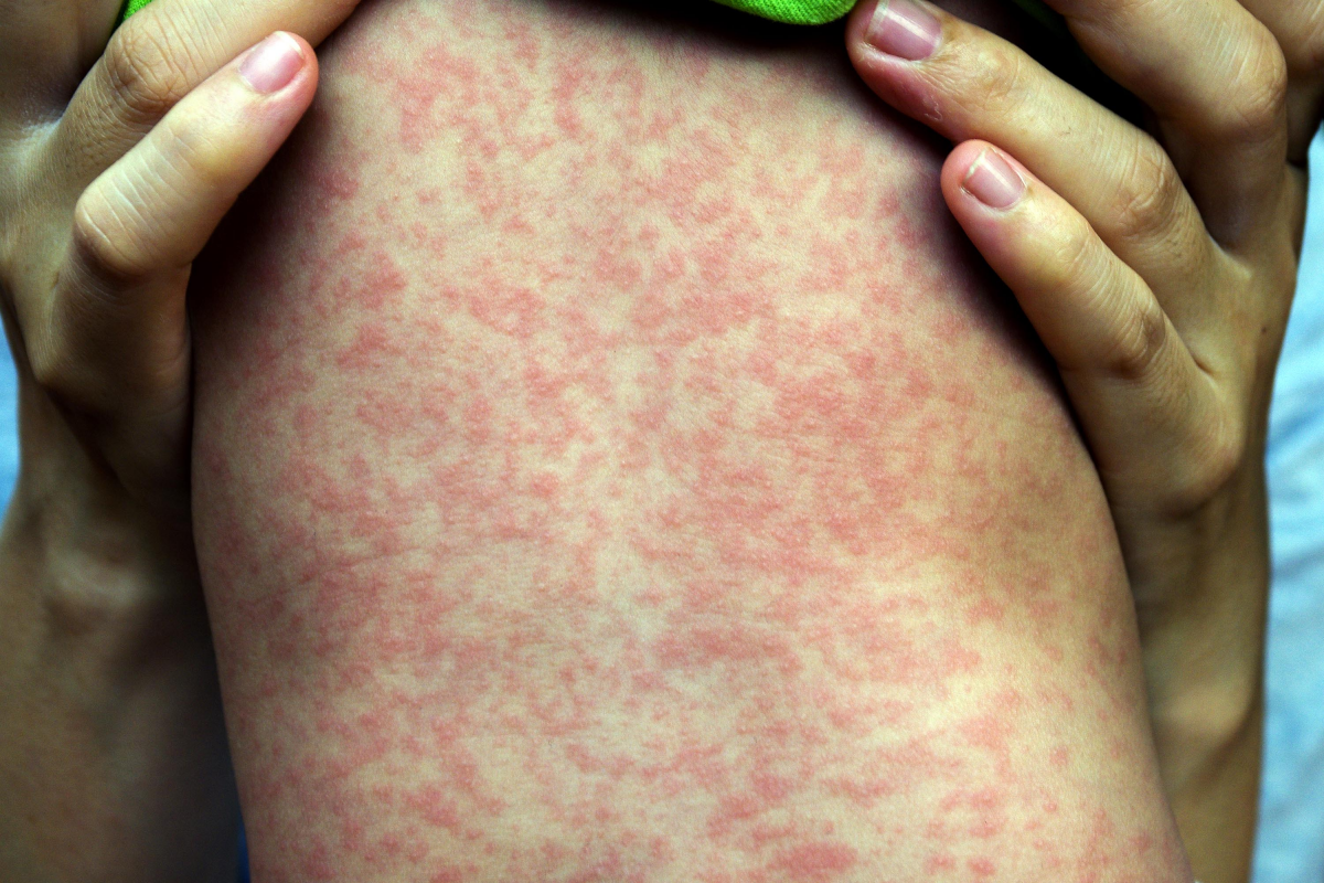In 2018, almost 350,000 measles cases were reported globally / Photo from Shutterstock