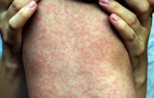 Over 57,000 measles cases recorded in Ukraine since year-start