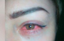 Украинка фактически ослепла на один глаз после косметической процедуры (видео)