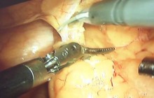 Робот-хирург провел первую операцию в Украине (видео)