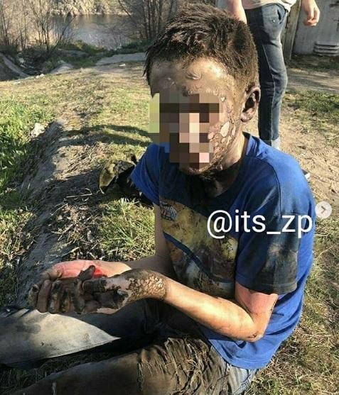 Подросток получил сильные ожоги рук / instagram its_zp