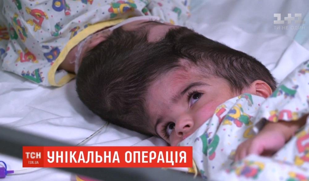В Великобритании врачи успешно разделили сиамских близнецов / Скриншот ТСН В Великобритании врачи успешно разделили сиамских близнецов / Скриншот ТСН