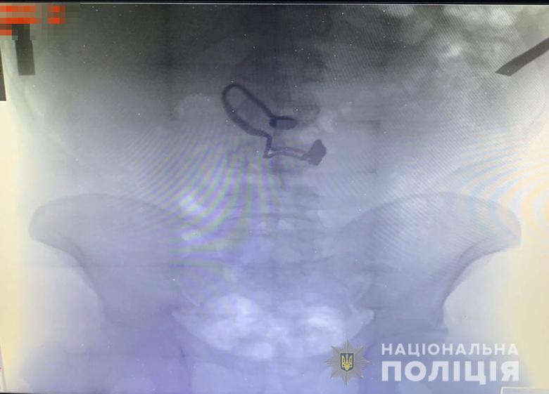 Сорванную цепочку мужчина проглотил / фото kyiv.npu.gov.ua Сорванную цепочку мужчина проглотил / фото kyiv.npu.gov.ua