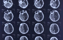 В России обнаружили пациента с половиной мозга