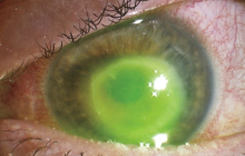 Жінка приймала душ у контактних лінзах і втратила зір (фото)