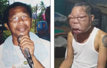 Через загадкову хворобу обличчя чоловіка розпухло до аномальних розмірів (фото, відео)