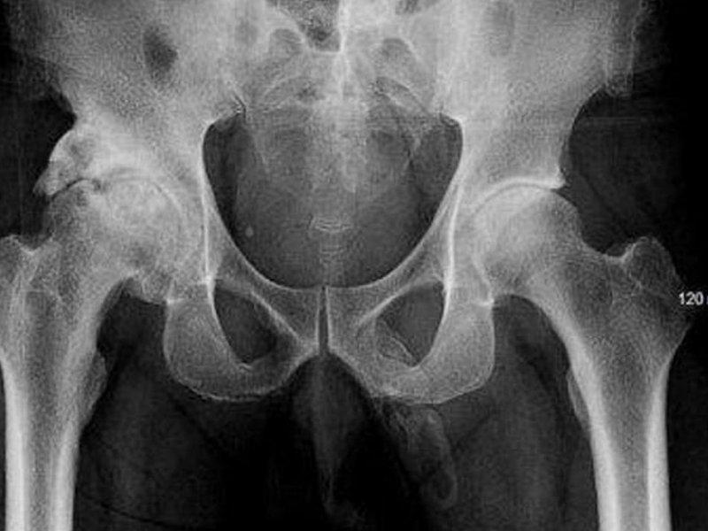 Мужчина обнаружил, что его пенис превращается в кость / фото medikforum.ru