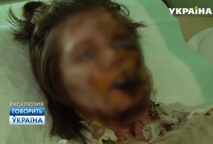 Шаповалова отримала численні опіки / Скріншот Шаповалова отримала численні опіки / Скріншот
