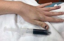 Кровь девушки посинела после приема обезболивающего (фото)