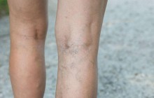 Що таке варикозне розширення вен та що з ним робити: поради Супрун