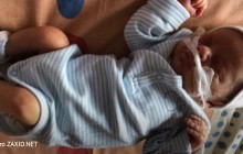 У Львові новонародженому видалили 2,5-кілограмову пухлину, маля зменшилось удвічі (фото)
