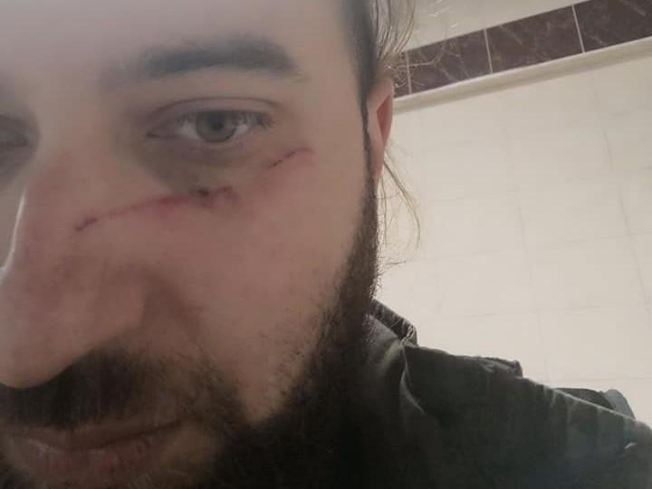 Павлов стверджує, що отримав закриту черепно-мозкову травму і струс мозку / фото: Свят Павлов/Facebook Павлов стверджує, що отримав закриту черепно-мозкову травму і струс мозку / фото: Свят Павлов/Facebook