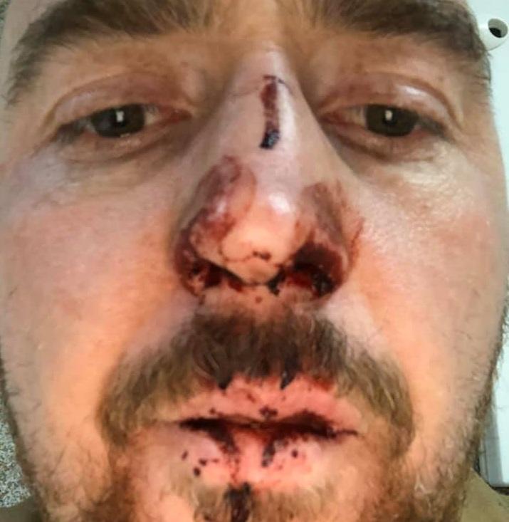 Поляк вдарив українця у ніс, коли той прийшов вимагати заборгованість зі зарплати / facebook.com/shootingstarco Поляк вдарив українця у ніс, коли той прийшов вимагати заборгованість зі зарплати / facebook.com/shootingstarco