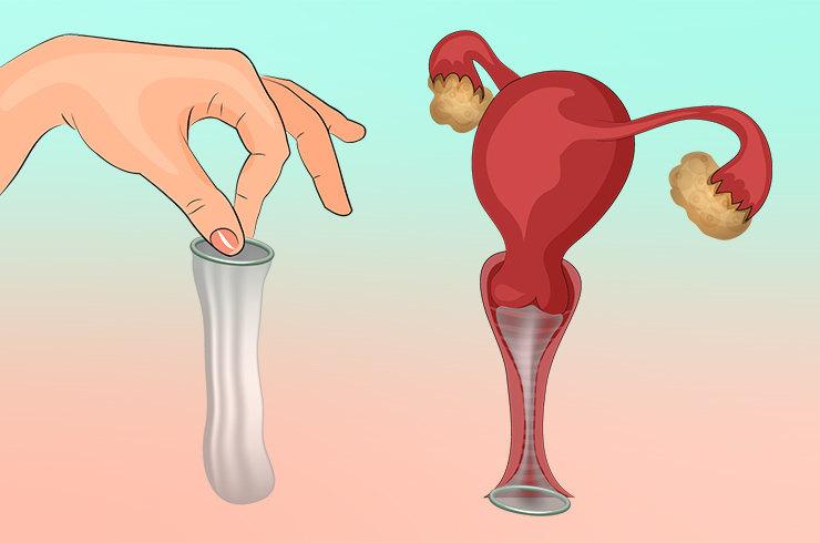 Женский презерватив / Иллюстрация Shutterstock