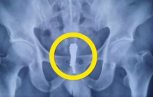 У Китаї у чоловіка в пенісі виявили ланцюжок з магнітних кульок