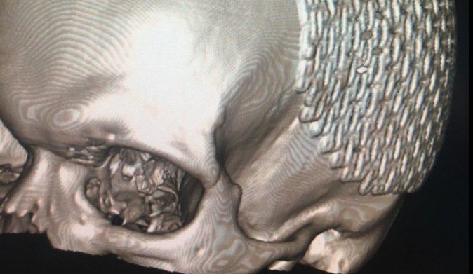 Дефект черепа хлопця накрили спеціальною пластиною / Facebook, Сергій Риженко