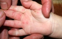 Вірус Коксакі в Україні: чим небезпечна хвороба, симптоми, ускладнення, лікування (фото)