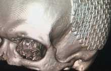 Місяць у комі: у Дніпрі прийшов до тями поранений на Донбасі 22-річний боєць