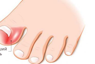 Врослий ніготь: причини, симптоми, лікування та профілактика