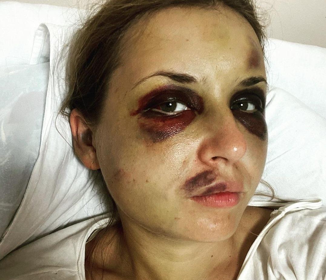 За її словами, вона четвертий день у такому стані / instagram.com/nastyalugova За її словами, вона четвертий день у такому стані / instagram.com/nastyalugova