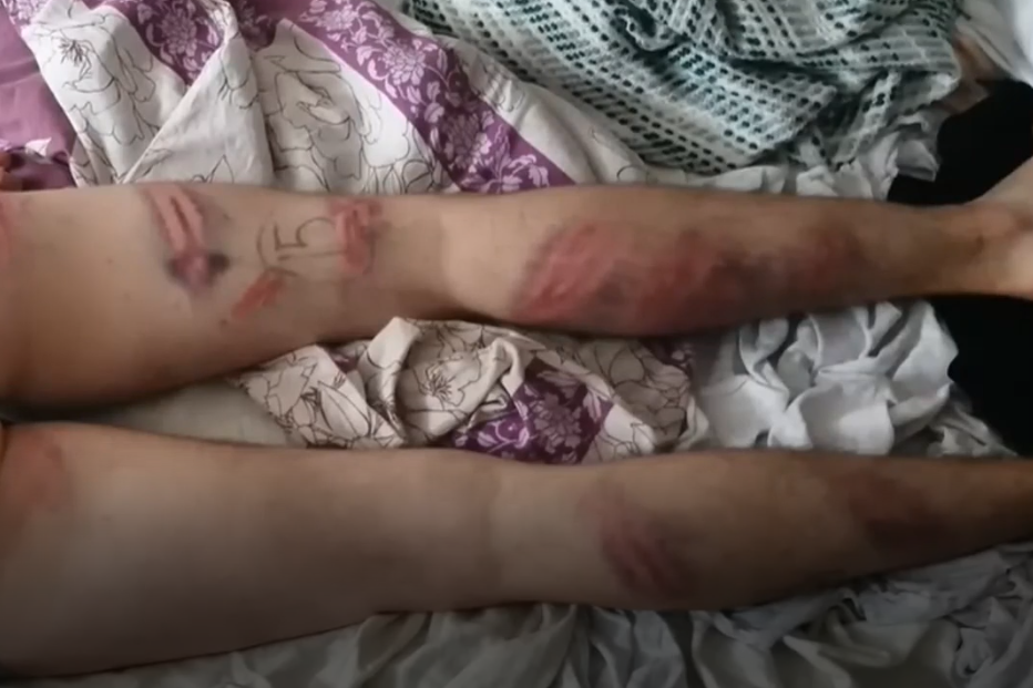 У хлопця численні гематоми на ногах / скріншот з відео У хлопця численні гематоми на ногах / скріншот з відео