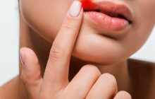 Ученые с помощью генной терапии смогли почти полностью излечить герпес
