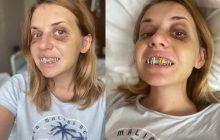 Затягнеться на кілька років: побита в поїзді УЗ Анастасія Лугова розповіла про реабілітацію