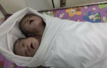 В Мьянме родился здоровый двухголовый ребенок (фото)