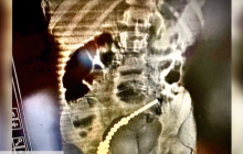 Семь дырок в кишечнике: во Львове популярная игрушка едва не убила двухлетнюю девочку (видео)