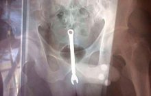 У Москві слюсарю два рази за свята діставали гайковий ключ із заднього проходу