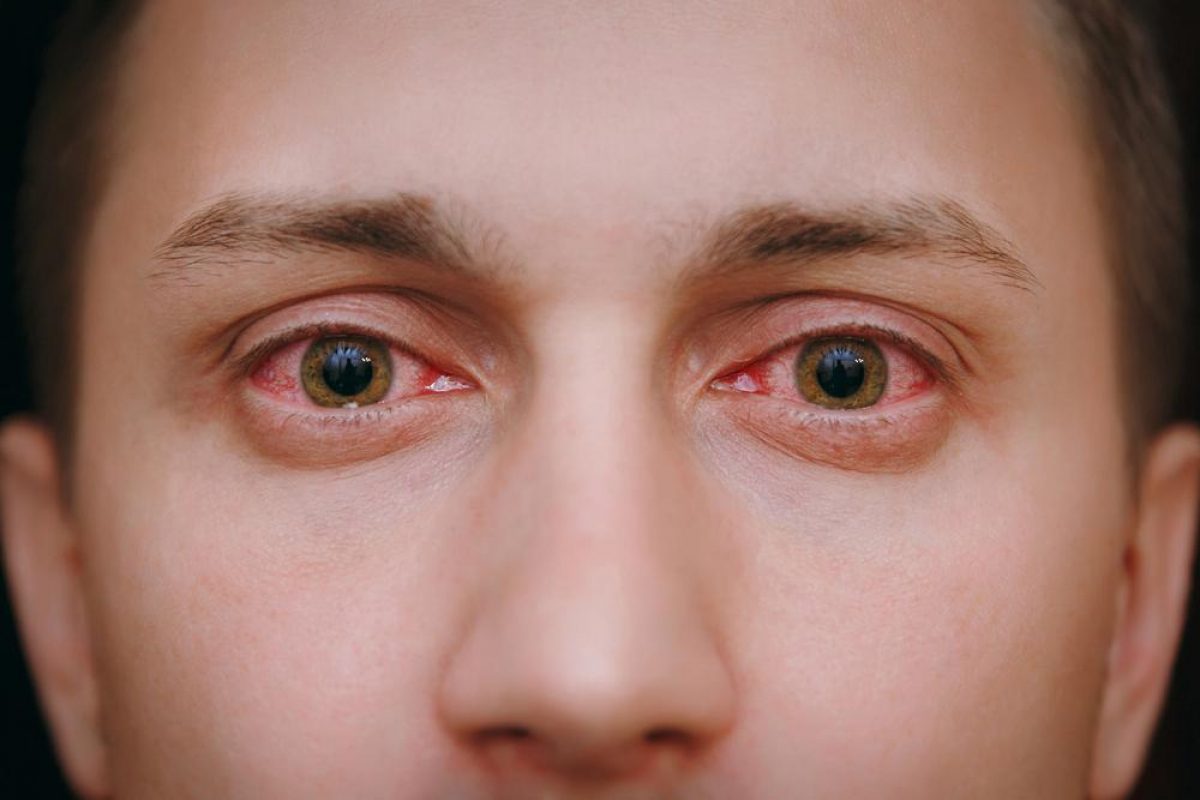Діагностика та лікування випадання очей