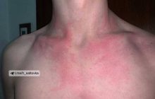 Пасажири поїзда УЗ поскаржилися на клопів у вагоні і показали укуси (фото)