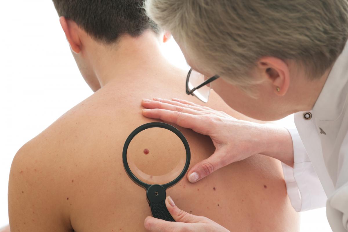 Меланома - это злокачественное новообразование кожи и наиболее опасное заболевание среди всех раковых заболеваний кожи / фото ua.depositphotos.com