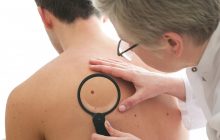 В Минздраве рассказали украинцам о симптомах и профилактике меланомы