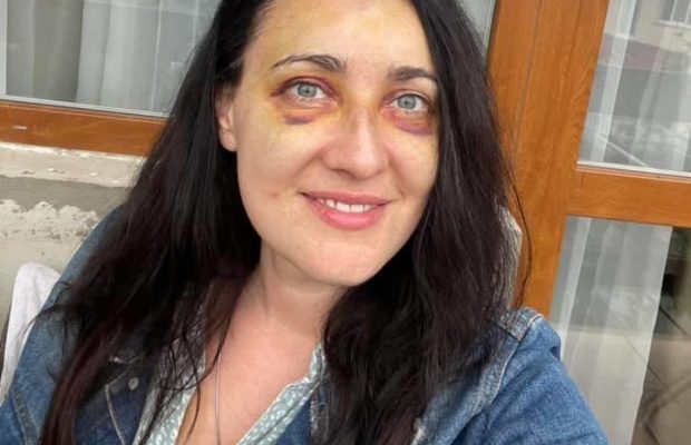 "Магия": Соломия Витвицкая показала, как визажисты замазали ее ужасные синяки на лице (фото)