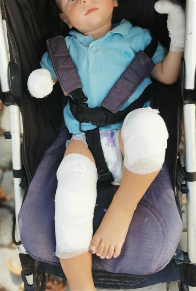 Мама хлопчика показала його опіки / фото - facebook Viktoriya Vikulevskaya Мама хлопчика показала його опіки / фото - facebook Viktoriya Vikulevskaya