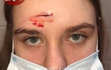 "Ти не знаєш, з ким зв‘язалась!": у київському ТРЦ жінка розсікла парасолькою лоб дівчині (фото)