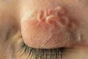 Діставали 12-сантиметрових черв'яків з очей: у трьох жителів Києва зафіксували рідкісне захворювання