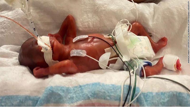 Мальчик родился с массой тела 420 граммов  \ фото UNIVERSITY OF ALABAMA AT BIRMINGHAM