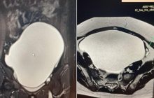 У Львові лікарі видалили з яєчника 14-річної дівчинки гігантську пухлину (фото)