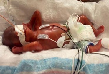 В Книге рекордов Гиннесса зафиксировали самые преждевременные роды в истории