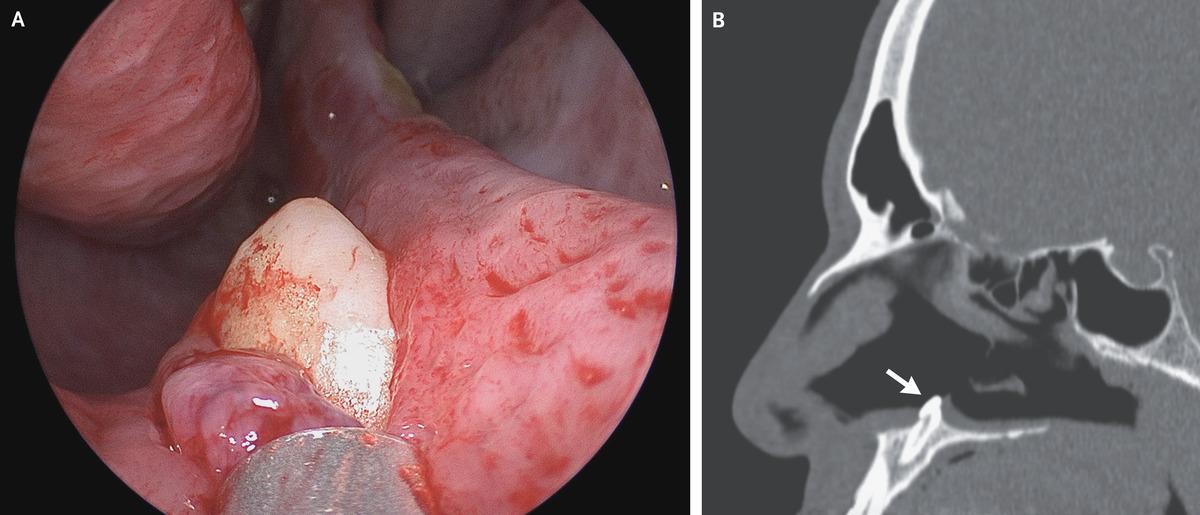 У американца в носу нашли 14-миллиметровый эктопический зуб / фото из журнала The New England Journal of Medicine
