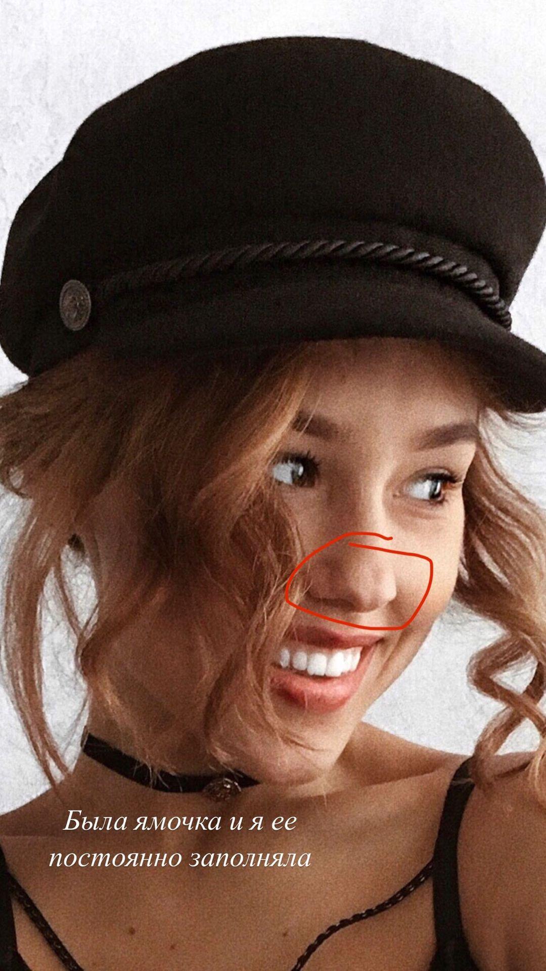 Даша Квиткова сделала ринопластику / instagram.com/kvittkova Даша Квиткова сделала ринопластику / instagram.com/kvittkova