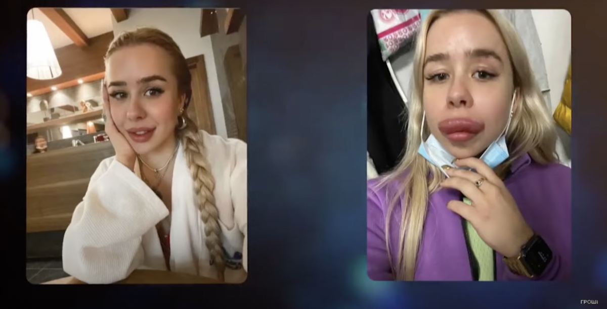 На відео показали, як косметологи спотворюють росіянок через санкції На відео показали, як косметологи спотворюють росіянок через санкції