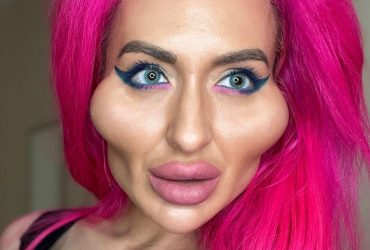 Украинка с огромными скулами показала результат очередной операции