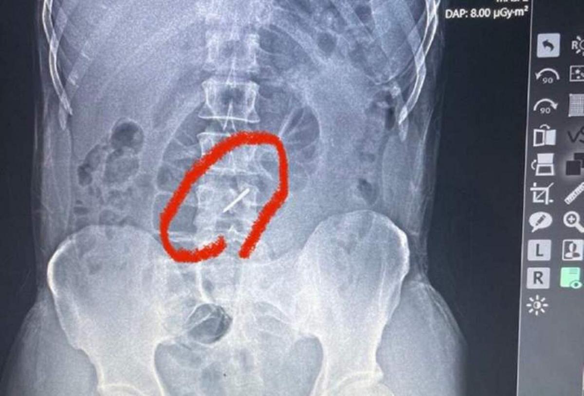 врачи были шокированы увиденным на рентгеновском снимке / фото zaxid.net