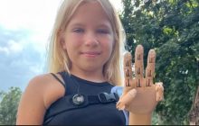 Зеленська показала дівчинку, яка втратила руку в Бучі і отримала унікальний протез у США